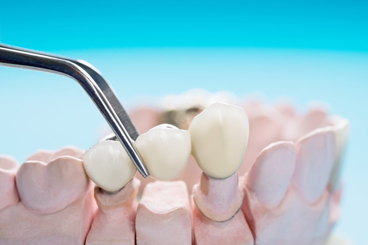 The Beauty of Prosthodontics: Reclaiming Dental Wellness
